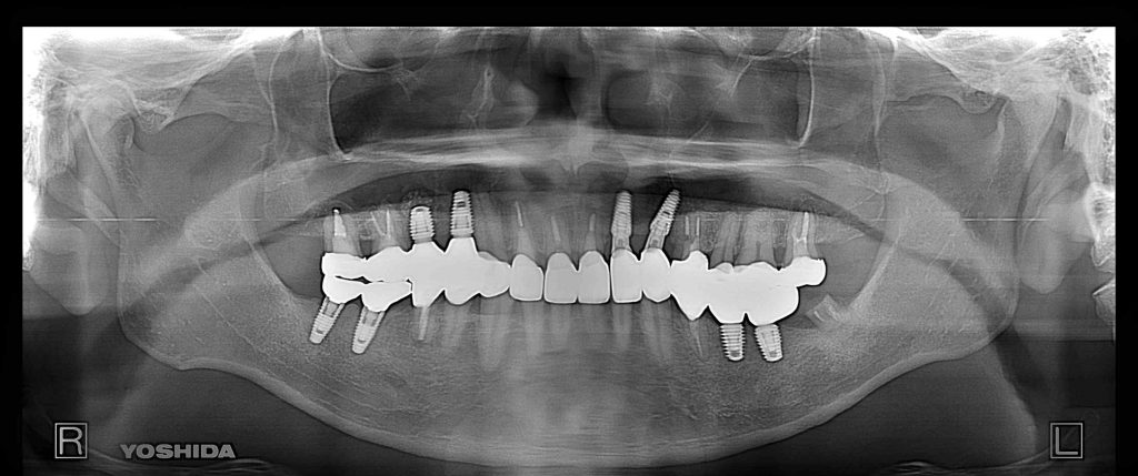 インプラント全体症例治療後