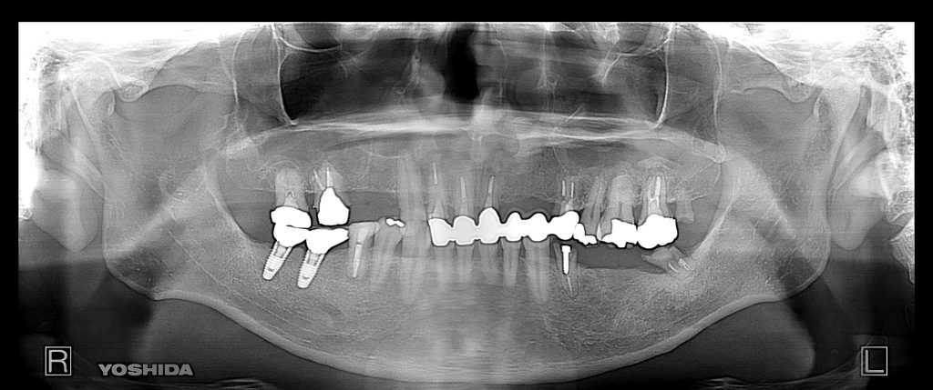 インプラント全体症例治療前