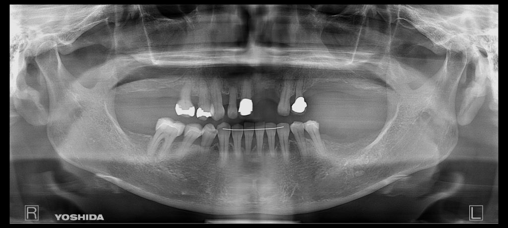 インプラント全体症例治療前