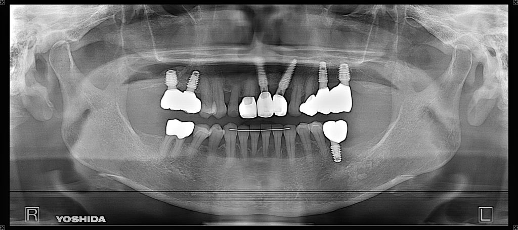 インプラント症例治療後