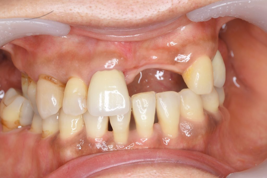 インプラント全体症例治療前