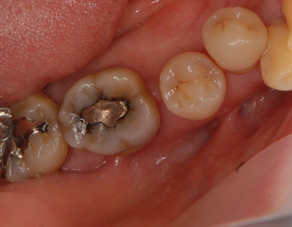インプラント奥歯症例治療前