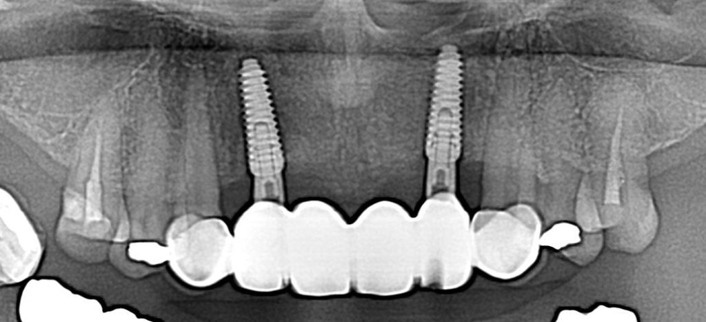 インプラント前歯症例治療後