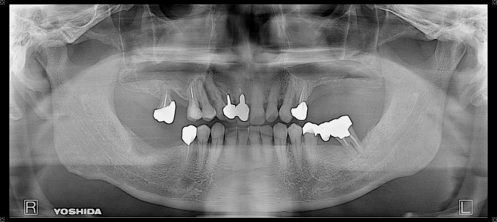 インプラント全体症例治療前