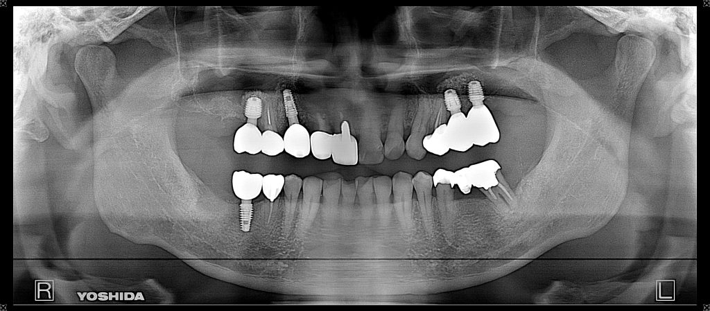 インプラント全体症例治療後