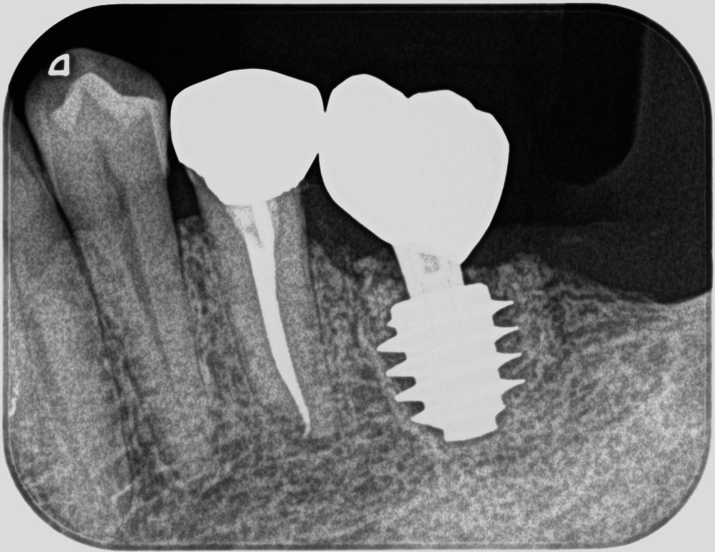 インプラント奥歯症例治療後