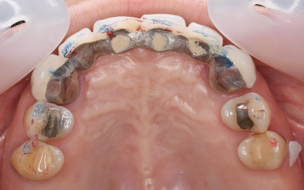 インプラント前歯症例治療前