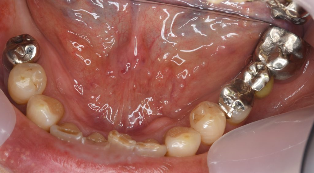 インプラント全体症例治療前