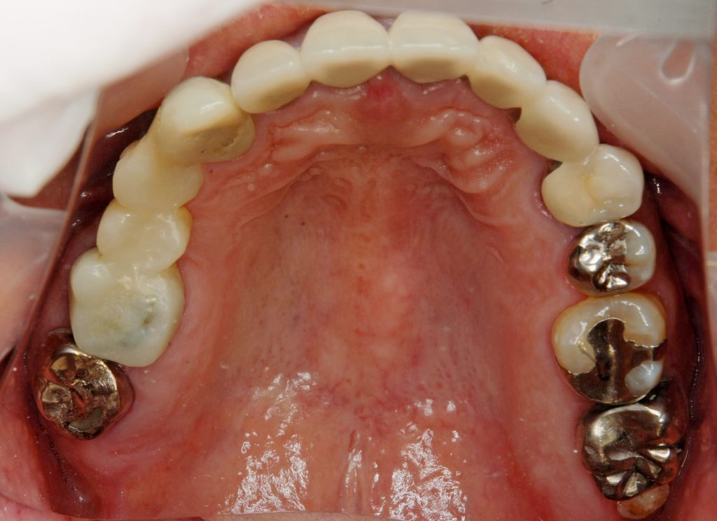 インプラント全体症例治療前