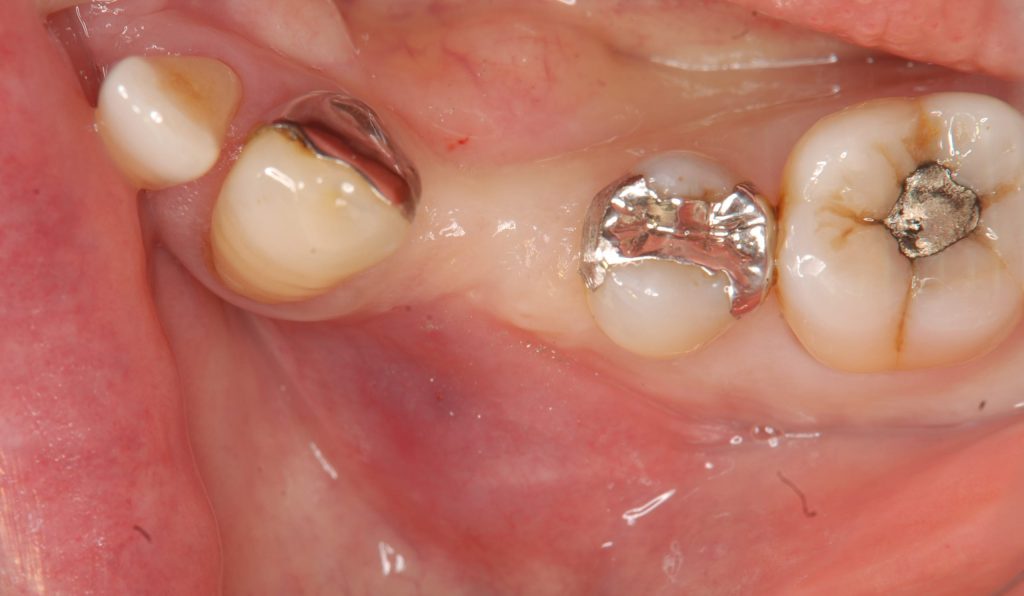 インプラント奥歯症例治療前