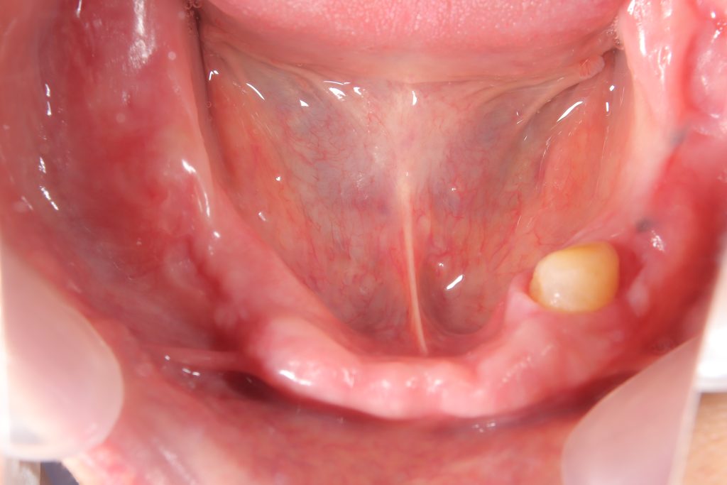 入れ歯症例治療前