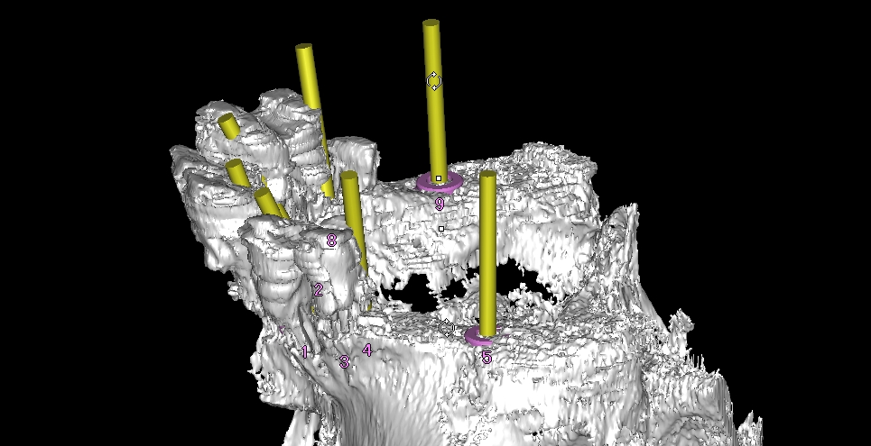インプラントの３D画像