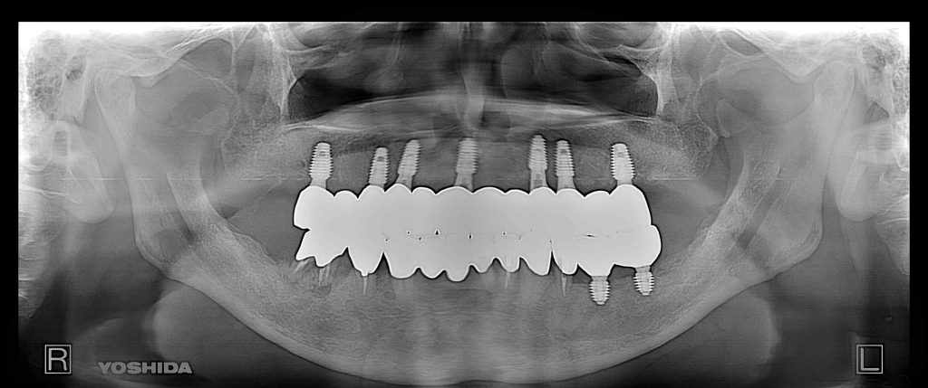 インプラント全体症例治療後