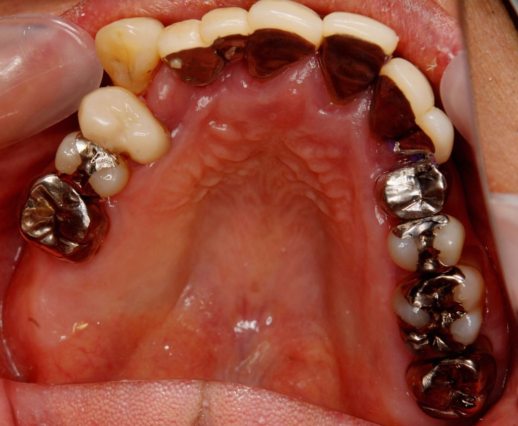 インプラント全体症例治療前