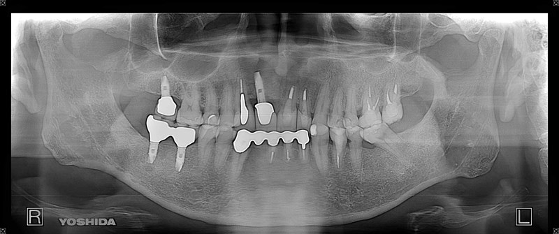 インプラント前歯症例治療後