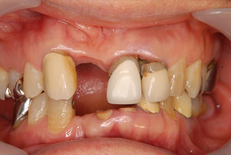インプラント前歯症例治療前