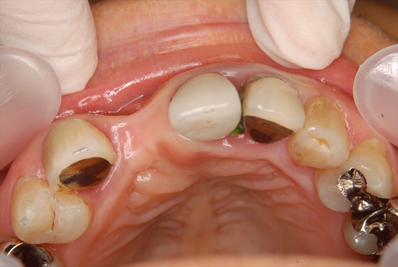 インプラント前歯症例治療前
