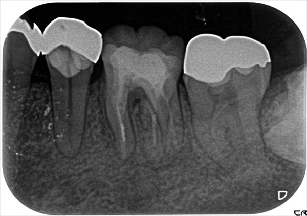 根管治療症例治療後